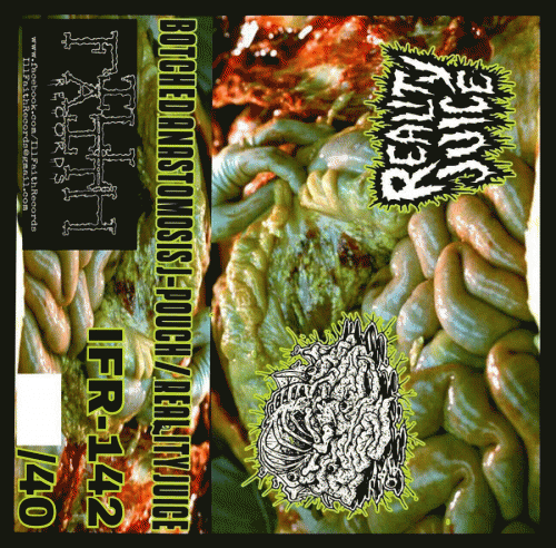 Botched Anastomosis J-Pouch : Botched Anastomosis J-Pouch - Reality Juice